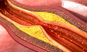 Ateroskleroz nədir? Qarşısı necə alınmalıdır?